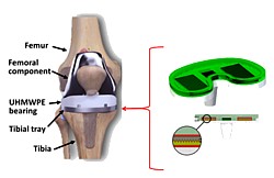 Knie-Implantat Grafik